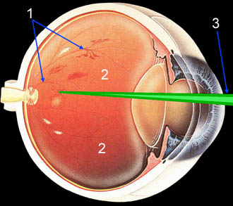 Retinopatia Diabetica